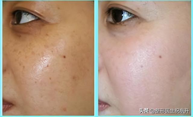 提拉緊致做什么醫(yī)美項(xiàng)目好（什么醫(yī)美可以提拉緊致）