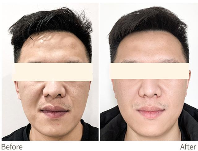 超聲炮是什么美容項(xiàng)目多少錢一次，做超聲炮多少錢？