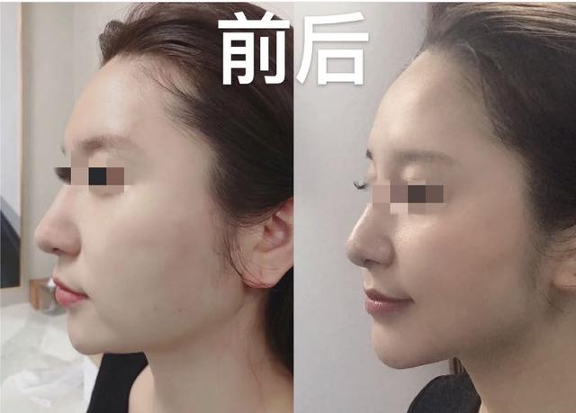 熱瑪吉是醫(yī)療美容項(xiàng)目嗎，請(qǐng)問(wèn)你這個(gè)美容熱瑪吉做一次多少錢？
