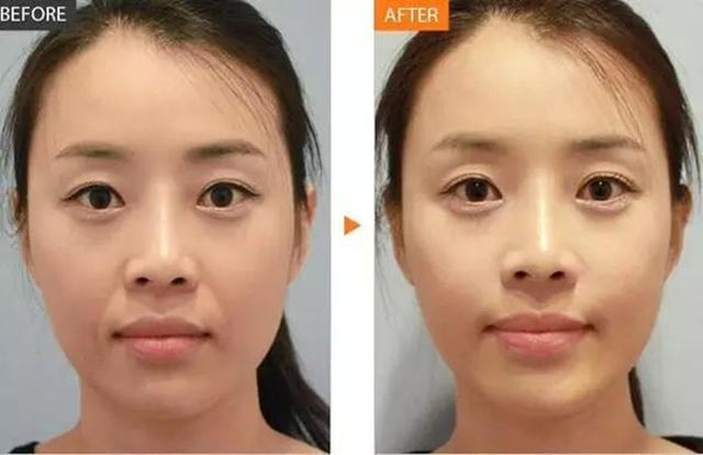 超聲炮是什么美容項(xiàng)目多少錢一次，做超聲炮多少錢？