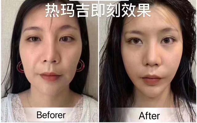 超聲炮是什么美容項(xiàng)目多少錢一次，做超聲炮多少錢？
