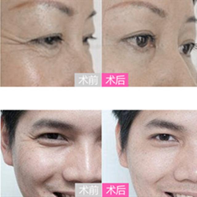 超聲炮是什么美容項(xiàng)目多少錢一次，做超聲炮多少錢？