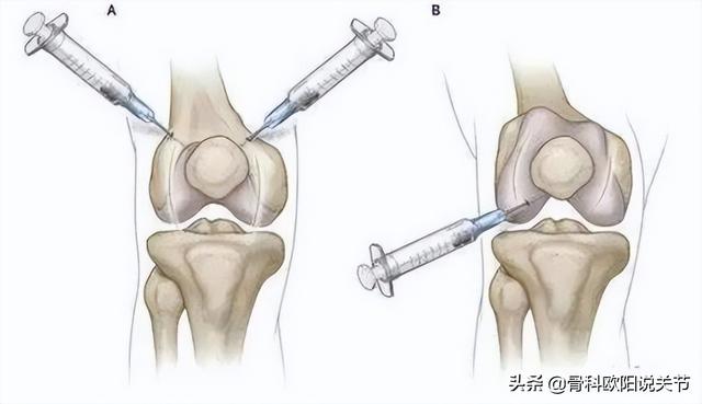 運(yùn)動(dòng)員打封閉針意味著什么（運(yùn)動(dòng)員打封閉針有什么用）