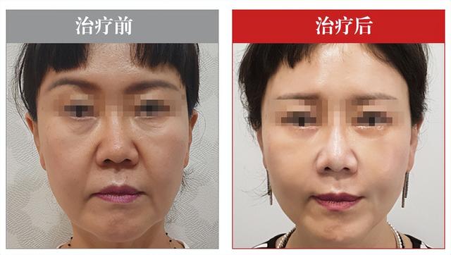 面部提升做什么項(xiàng)目最好呢醫(yī)生，面部提升都有什么項(xiàng)目