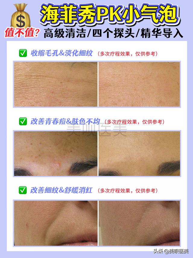 海菲秀是什么美容項目，海菲秀多長時間？